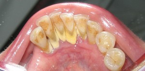 800px-MandibularAnteriorCalculus Bild på tandsten