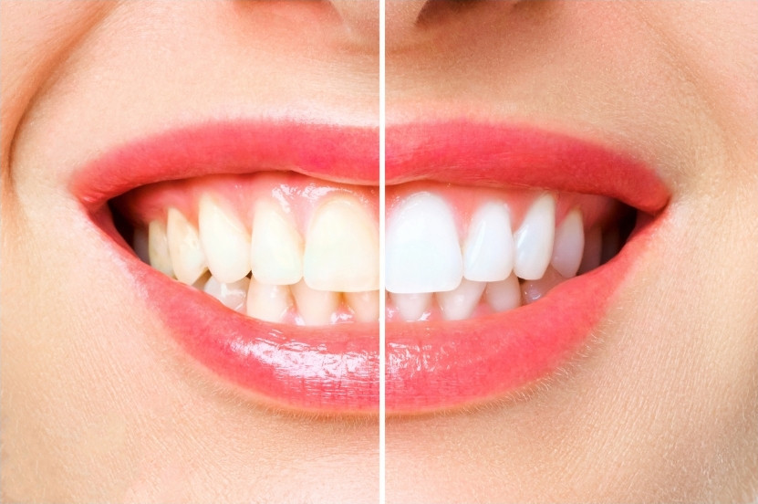 tandblekning bilder före och efter
